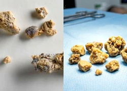 Sỏi thận có thể tự đào thải trong bao lâu, khi nào cần can thiệp?