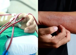 Thận gặp nguy hiểm từ 1 dấu hiệu trên da