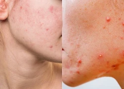 7 yếu tố dẫn đến tình trạng mụn viêm trên da