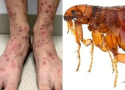 Nhiều người da nổi kín sẩn đỏ, ngứa ngáy vì bọ chét