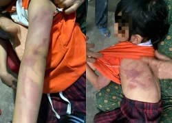 Bé gái lớp 2 bị bạn đánh bầm tím da vì lời hứa "cho kẹo"