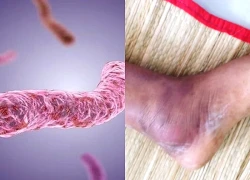 Bệnh "sốt đất" khiến hàng chục người ở Thái Lan tử vong nguy hiểm ra sao?