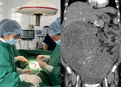 Người phụ nữ Hà Nội mang khối u tử cung nặng 9kg