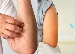 Nhận diện và xử trí phản ứng dị ứng, miễn dịch sau tiêm vaccine