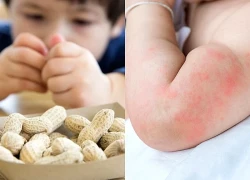 Những triệu chứng cảnh báo trẻ bị dị ứng thức ăn