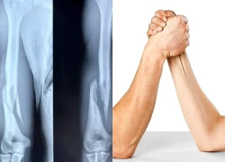 Vật tay tưởng vô hại, vì sao nhiều người bị gãy xương?