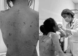 Người phụ nữ Hải Phòng bị tróc da như ‘cua lột’, lý do tự mua thuốc dị ứng
