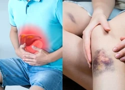 7 dấu hiệu hay gặp ở người mắc bệnh gan