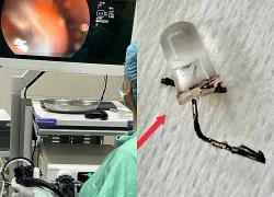 Cấp cứu thành công bé 9 tháng tuổi bị bóng đèn LED mắc kẹt trong phế quản