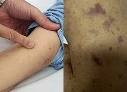 Cháu tử vong do não mô cầu, chú ruột 40 tuổi cũng nhiễm bệnh