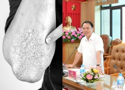 Không dám bắt tay ai vì mặc cảm căn bệnh khiến da bong tróc