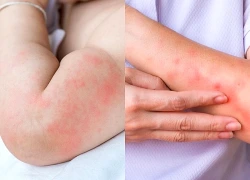 Nắng nóng khiến nguy cơ viêm da gia tăng, phòng ngừa thế nào?