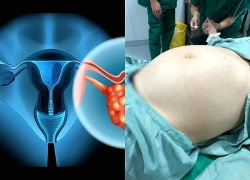 Người phụ nữ mang khối u buồng trứng nặng 12kg