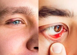 Nguyên nhân gây cộm mắt và cách khắc phục