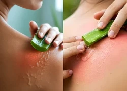 Cách phục hồi làn da bỏng nắng sau khi đi biển
