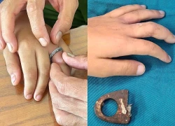 Đưa học sinh bị kẹt ngón tay trong vòng sắt đến cảnh sát nhờ hỗ trợ