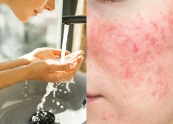Thử thách "nguy hiểm cho da" để tự chữa lành gây tranh cãi