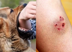 Người đàn ông ra đi thương tâm sau 14 ngày phát bệnh dại