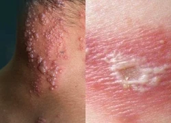 Zona thần kinh nguy hiểm thế nào mà khiến người già đau đớn suốt nhiều năm?