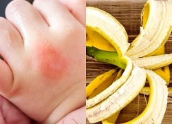 Cách sử dụng vỏ chuối để trị 3 tình trạng ngoài da thường gặp
