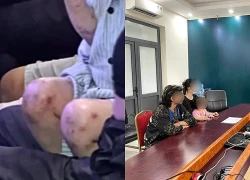 Công an lên tiếng vụ bé gái 3 tuổi nghi bị bạo hành tại quán bia ở Hà Nội