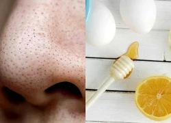 5 cách làm mặt nạ trị mụn đầu đen tại nhà từ nguyên liệu tự nhiên