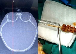 Bé gái 2,5 tuổi bị que xiên thịt đâm xuyên hốc mắt