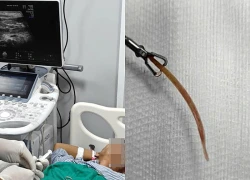 Đau bụng suốt 10 ngày, bất ngờ phát hiện tăm tre đâm thủng đại tràng
