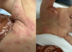 Loài ký sinh trùng tưởng đã 'biến mất' tấn công một gia đình ở Tây Ninh