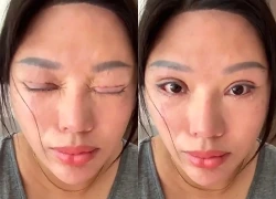 Người phụ nữ không thể nhắm mắt khi ngủ sau ca phẫu thuật thẩm mỹ hỏng