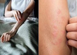 Ngứa da nhiều ban đêm cảnh giác với suy thận