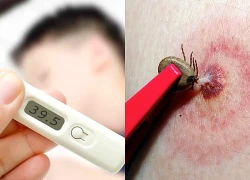 Suy đa tạng do mò đốt, đặc trưng của bệnh sốt mò cần biết