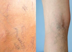 8 cách giúp cải thiện bệnh suy giãn tĩnh mạch tại nhà