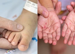 Bé gái nguy kịch vì căn bệnh quen thuộc