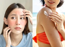 Cách xử lý da cháy nắng và chọn kem chống nắng an toàn