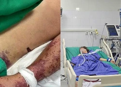 Tưởng cảm cúm, hóa ra dính vi khuẩn 'ăn thịt người'