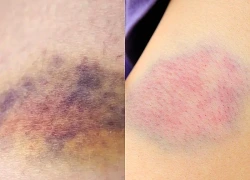 Xuất hiện nhiều vết bầm tím không rõ nguyên nhân cảnh giác với giảm tiểu cầu
