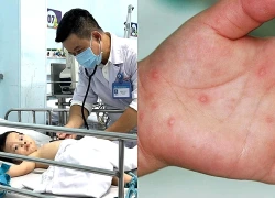 Bệnh tay chân miệng gia tăng mạnh, Cà Mau tăng cường giám sát, phòng chống bệnh