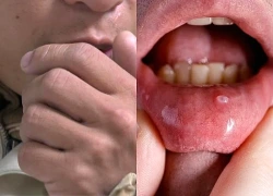 Đi khám vì dấu hiệu lạ, người đàn ông ngỡ ngàng khi biết mắc ung thư