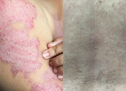 Cảnh giác với căn bệnh không lây nhưng nguy hiểm