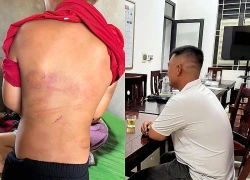 Công an xác minh vụ bé trai 10 tuổi có nhiều vết bầm tím trên cơ thể