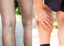 Suýt mất chân vì tắc động mạch cấp chi dưới, bác sĩ cảnh báo dấu hiệu không nên bỏ qua