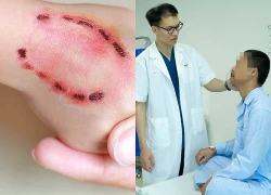 Vết thương do người cắn nguy hiểm như thế nào?