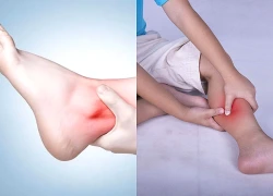Từ dấu hiệu đau mỏi chân, người phụ nữ đối mặt với căn bệnh nguy hiểm