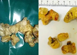 Vì sao sỏi thận có viên tròn nhẵn, viên lại sắc nhọn như san hô?
