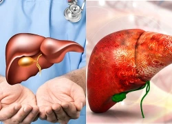 14 dấu hiệu cảnh báo gan bị tổn thương cần chú ý trước khi quá muộn