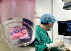 Bé trai 12 tuổi suýt thủng thực quản vì nuốt viên thuốc còn nguyên vỉ sắc nhọn