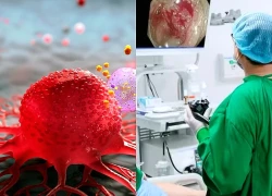 Những dấu hiệu tiêu hóa tưởng vô hại nhưng có thể là cảnh báo ung thư