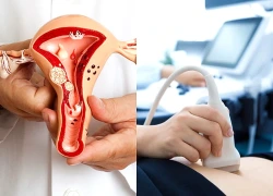 Cảnh báo u buồng trứng ở phụ nữ lớn tuổi