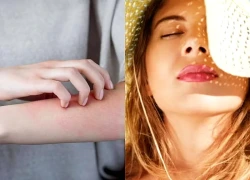 Gợi ý xử lý cháy nắng, chống nắng đúng cách
